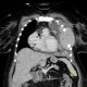 Tumour of thorax wall: CT - Computed tomography